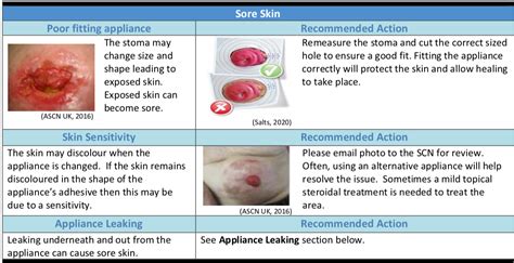 Stoma Care – GP Gateway