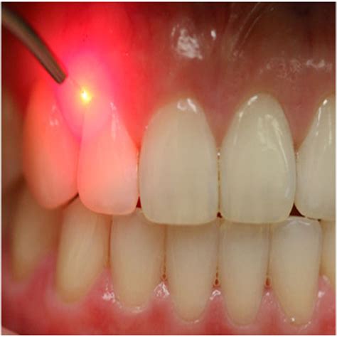 Laser Dentistry