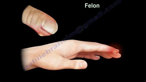 Infection of the finger. what is a felon finger. Diagnosis and treatment of a felon. - YouTube