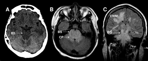 Hypertensive Brainstem Encephalopathy | Circulation