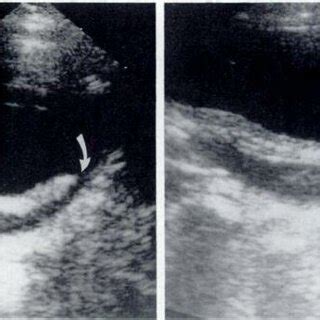 -Normal appearance of collapsed ureterocele after endoscopic incision.... | Download Scientific ...