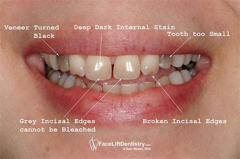 Tetracycline Stains on Teeth | Long Live Fitness