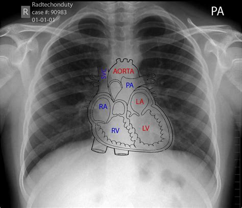 Abnormal Chest Xray