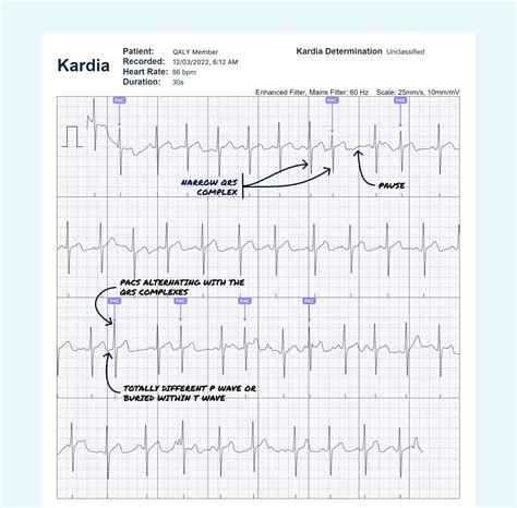 Atrial Bigeminy Vs. Ventricular Bigeminy on Your Watch ECG | Qaly