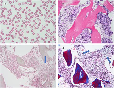 Peripheral blood and bone marrow morphologic findings. (a) The ...