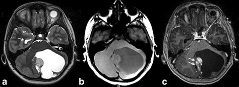 Neuroimaging of pediatric posterior fossa tumors including review of ...