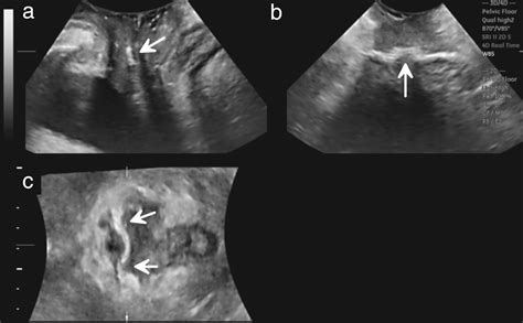 Space Of Retzius Ultrasound