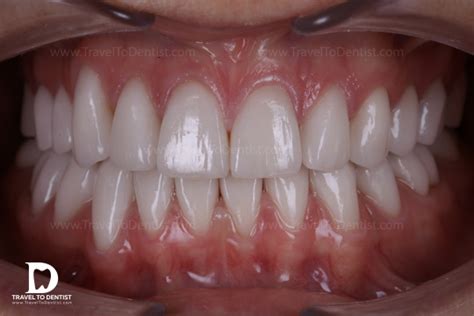 Emax dental veneers - life changing change. Clinical case + Photos