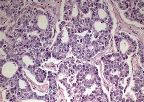 Pathology Outlines - Acinar cell carcinoma