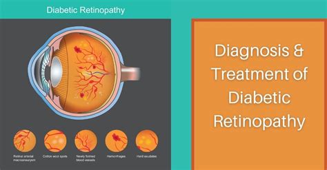 Diagnosis and Treatment of Diabetic Retinopathy