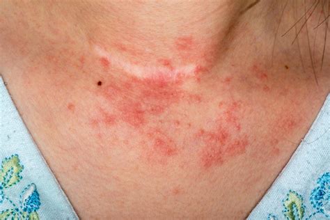 Rash on Chest Pictures, Causes, Symptoms, Remedies and Treatment ...