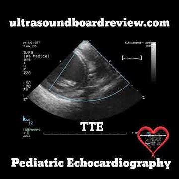 ALCAPA Echocardiography - YouTube