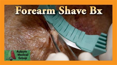 Forearm Shave Biopsy | Auburn Medical Group - YouTube