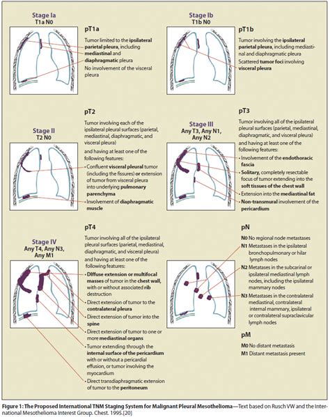 Pin on mesothelioma symptoms treatment