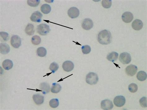 Summary of Abnormal Red Blood Cell Morphologies and Disease States ...