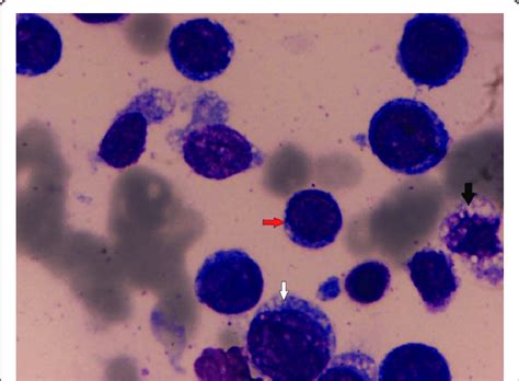 The erythroid precursors show dysplastic morphology (white arrow), with... | Download Scientific ...