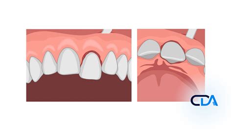 Tooth Luxation: Types, Causes, Symptoms, and Treatment