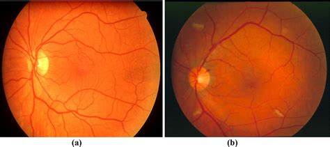 Retinal images: a normal, b abnormal fundus | Download Scientific Diagram