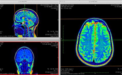 3d - Dicom files: how to extract brain/organ from MRI scan? - Graphic Design Stack Exchange