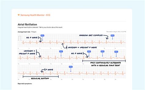 Ventricular Bigeminy Vs. Premature Ventricular Contraction (Couplet) on ...