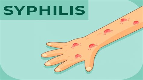 Syphilis: Causes, Symptoms, Diagnosis & Treatment - Boldsky.com