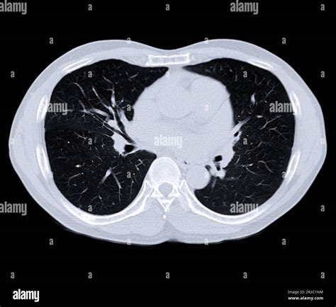 CT scan of Chest or lung for screening lung nodules and lung cancer ...