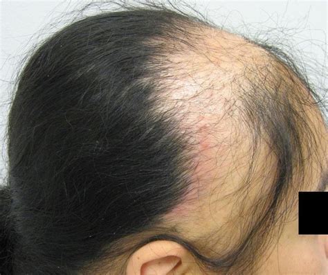 Non Surgical Hair Restoration : Traction Alopecia Cure