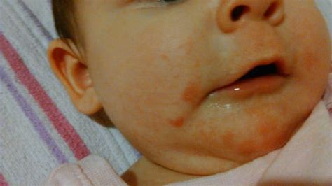 Is this a teething rash? | BabyCenter