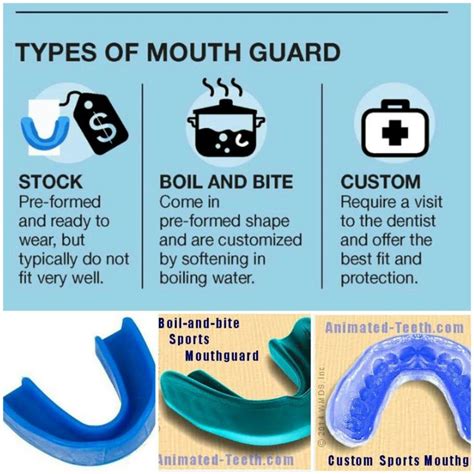 Mouthguard types | Mouth guard, Dental, Dentist