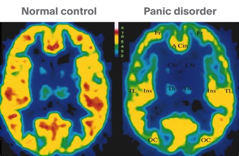 Panic Disorder Brain