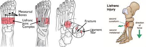 Lisfranc injury: A runners worst nightmare: The Lisfranc injury ...