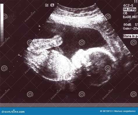 Black Baby Ultrasound