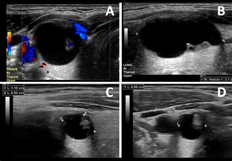 Ethanol Ablation For The Treatment Of Cystic And Predominantly