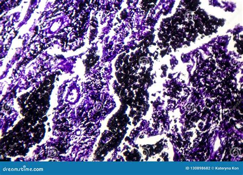 Histopathology Of Silicosis, Light Micrograph Royalty-Free Stock Image ...