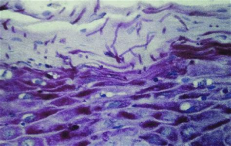 Oral Candidiasis Histology