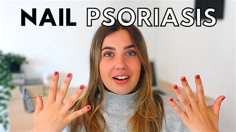 NAIL PSORIASIS TREATMENT AT HOME // psoriasis update and storytime - YouTube