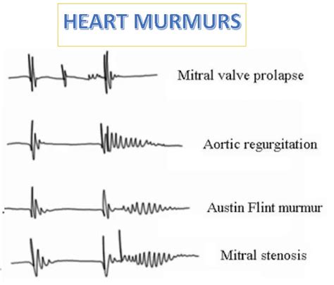 What is a Heart Murmur? - Turkey Istanbul Medical