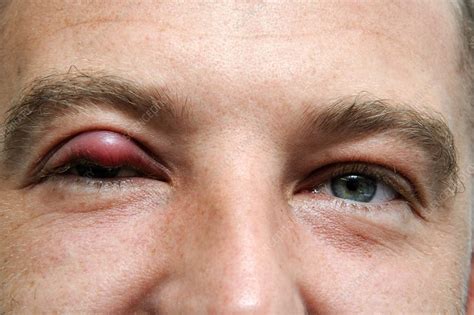 Stye on upper right eyelid - Stock Image - C022/5501 - Science Photo Library