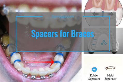 SPACERS FOR BRACES - Do They Hurt - Precautions - Removal Time