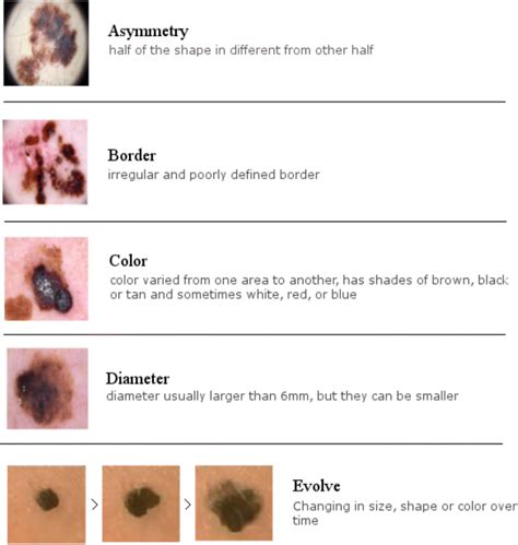 ABCDE Criteria for Skin Cancer Diagnosis. The higher the similarity of... | Download Scientific ...