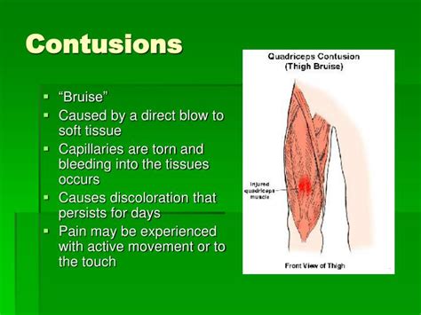 PPT - Chapter 13: Recognizing Different Sports Injuries PowerPoint Presentation - ID:481974