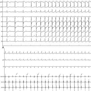 A. The 12-lead ECG showed a narrow QRS complex tachycardia... | Download Scientific Diagram