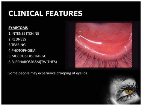 Vernal kerato conjunctivitis