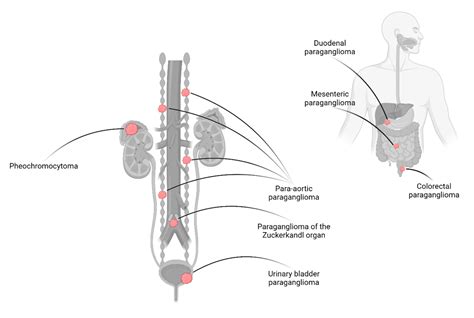 Cancers | Free Full-Text | Pheochromocytomas and Abdominal Paragangliomas: A Practical Guidance