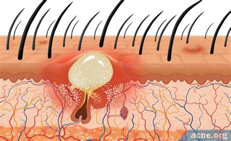 Scalp Acne - Info & Treatment Options - Acne.org