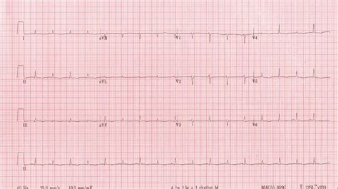 Cardiac Tamponade – Cardio Guide