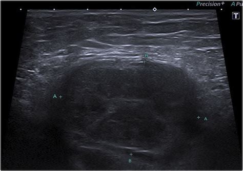 Groin Hematoma Ultrasound