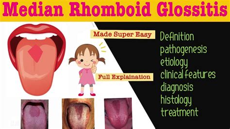 Median Rhomboid Glossitis | Developmental disturbances of the tongue | - YouTube