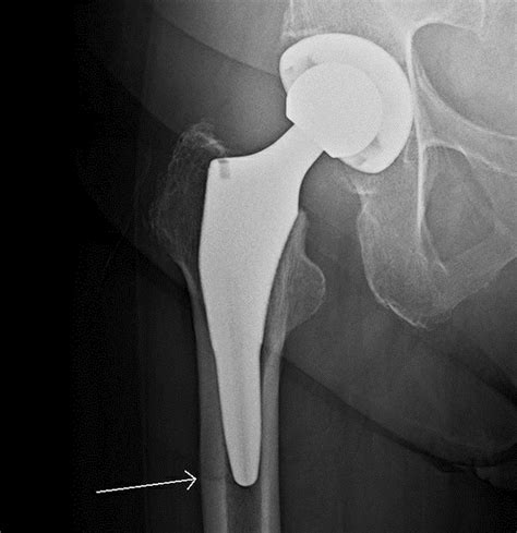 Anteroposterior radiograph, six weeks post-total hip arthroplasty. The ...