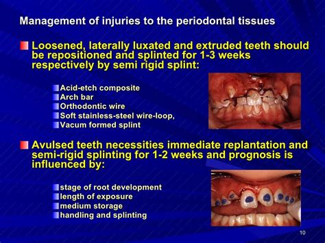 Dento Alveolar Fractures